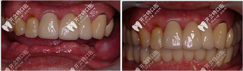 美奧口腔張書桓種植牙案例二