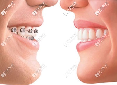 聽說濮陽矯正牙齒比較好的醫(yī)院是這兩家,還有正畸價(jià)格表哦