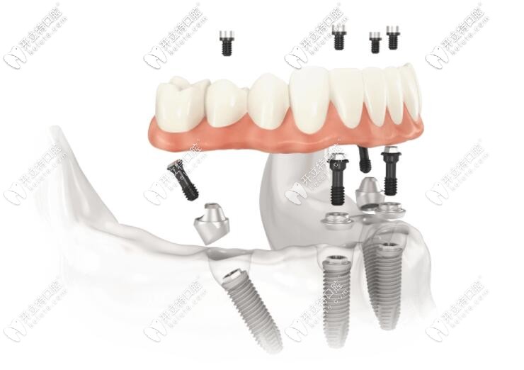 all-on-4/6全口種植牙 all-on-4/6全口種植牙