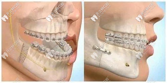 地包天做代償性正畸和正頜手術(shù)后的效果