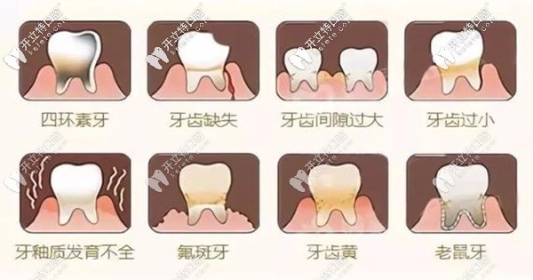 合肥貝杰口腔全瓷貼面修復的優(yōu)點