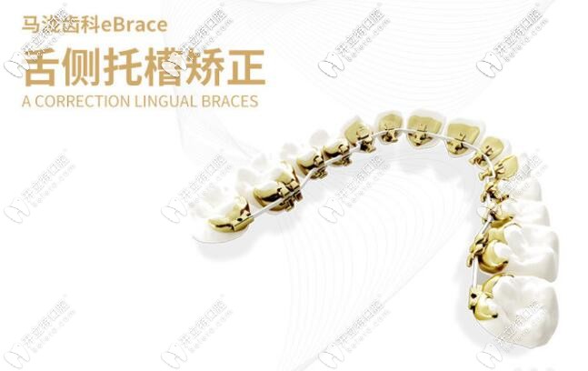 ebrace舌側(cè)隱形矯正 ebrace舌側(cè)隱形矯正