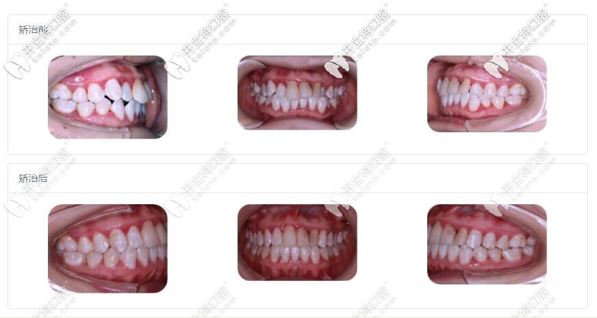 拔牙矯正案例圖