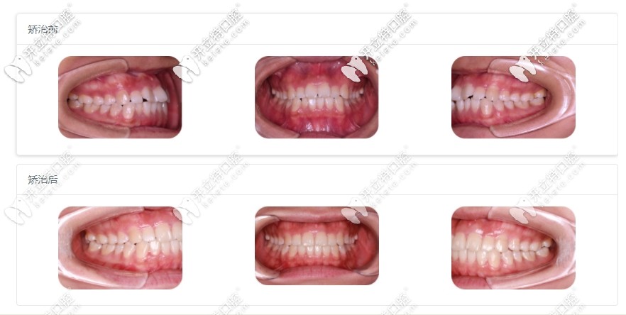 牙齒擁擠矯正效果圖