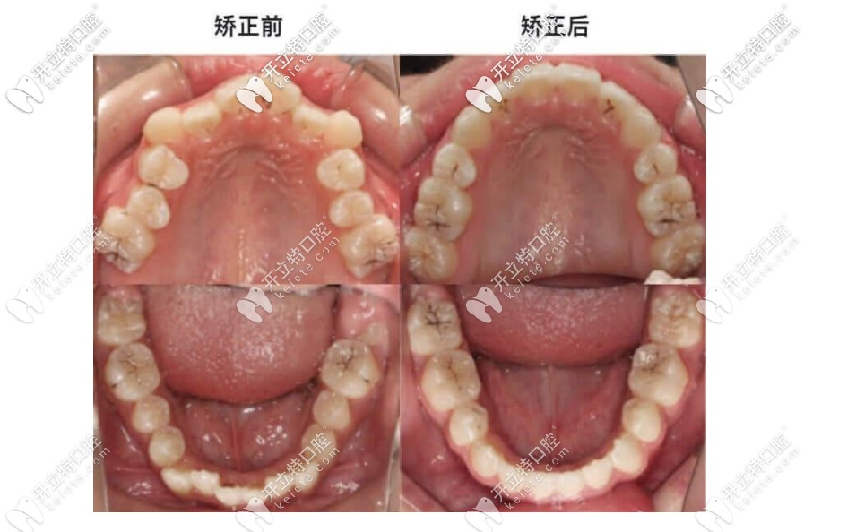 百適美矯正前后對比圖