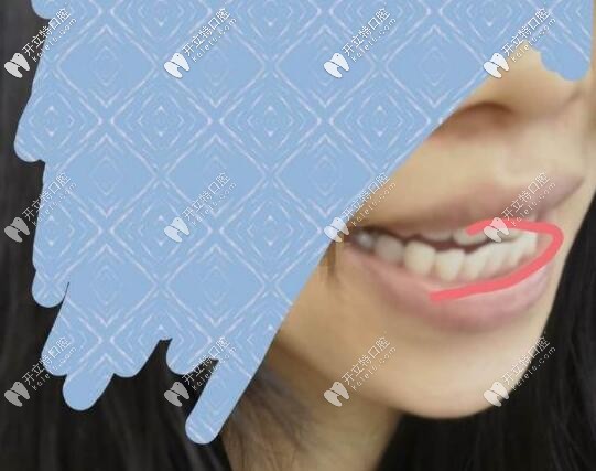 牙齒矯正反彈 牙齒矯正反彈