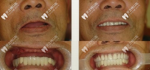 上半口缺牙后做半口即刻負(fù)重種植牙