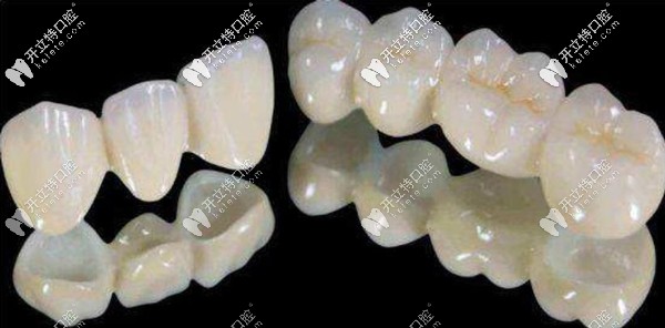 美晶瓷PK愛(ài)爾創(chuàng)全瓷牙優(yōu)缺點(diǎn)