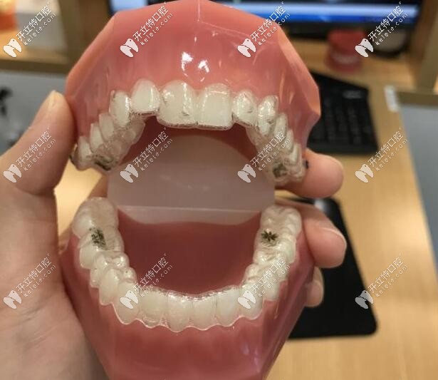 隱適美矯正牙套 隱適美矯正牙套