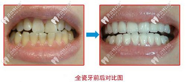 全瓷牙前后對(duì)比