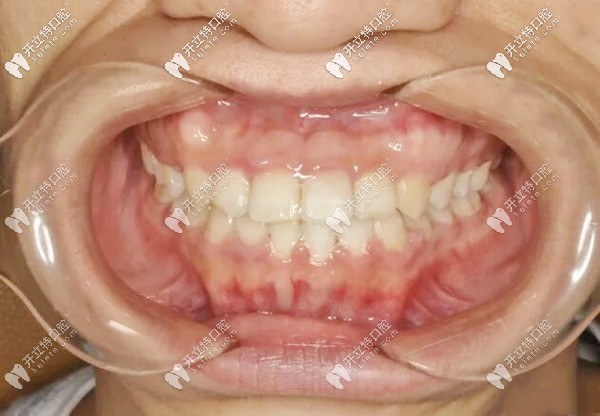 地包天牙齒矯正后的照片 地包天牙齒矯正后的照片