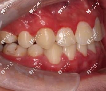 矯正后的牙齒情況