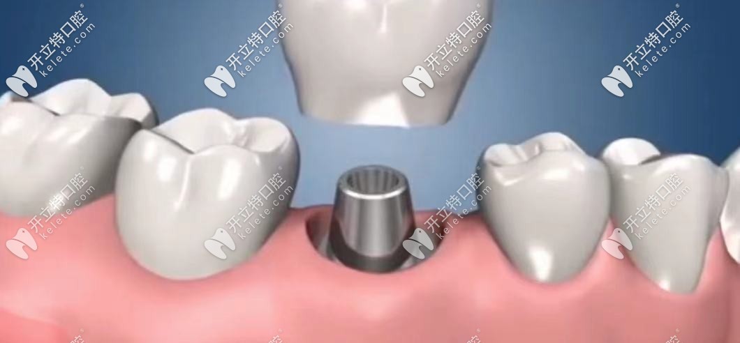 安裝基臺(tái)將牙冠和種植體連接固定，完成種植牙種植