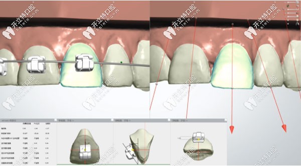 置略馬瀧齒科的數(shù)字化正畸技術(shù)