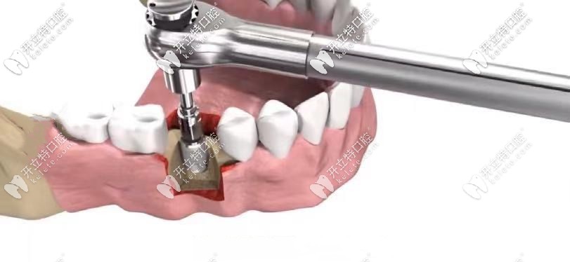 將種植體擰入牙槽骨螺紋孔中，擰緊螺釘固定