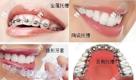 ebrace舌側矯正牙套大概多少費用?效果相較于唇側哪個好