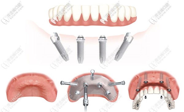 all-on-4種植牙技術(shù)示意圖