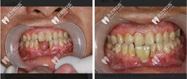 合肥貝杰口腔即拔即種案例