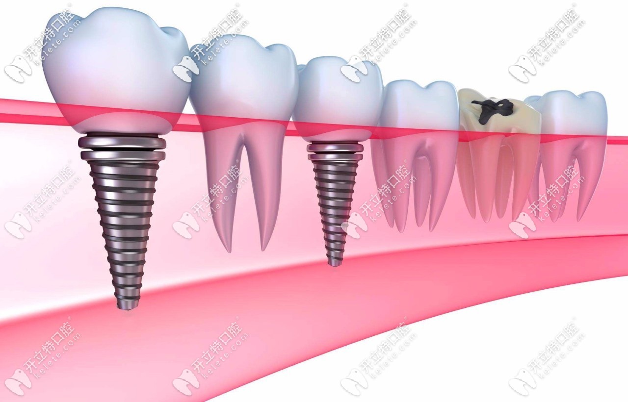 進(jìn)口種植牙圖示