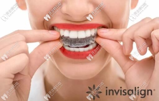細說隱適美m(xù)oderate和標準版的區(qū)別,價格和牙套數(shù)目都不同哦