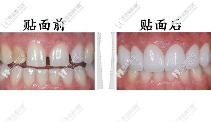 牙齒貼面前后對(duì)比圖