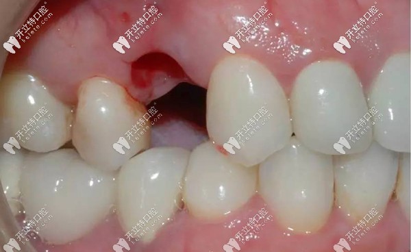 種植前的缺牙部位