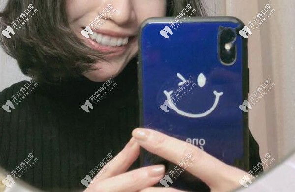 矯正期間牙套臉 矯正期間牙套臉