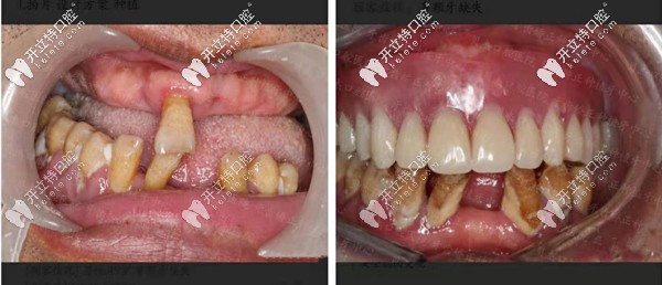 合肥貝杰口腔all-on-4種植牙案例