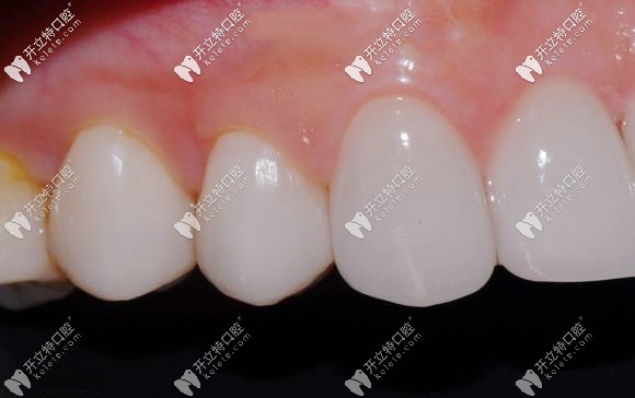 種植牙后的使用情況