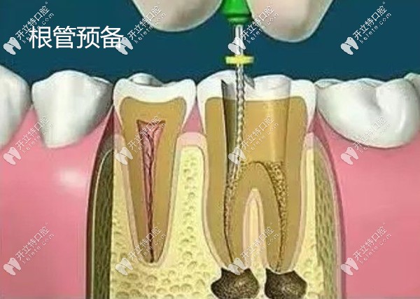高清版牙齒根管治療過(guò)程的視頻,告訴你多久能完成治療
