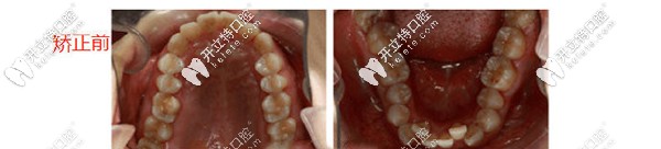 矯正前上頜下頜圖