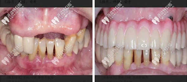 合肥貝杰口腔半口種植牙案例