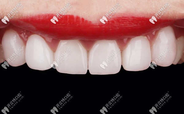 價(jià)格相差不多的國(guó)產(chǎn)和進(jìn)口全瓷牙效果圖