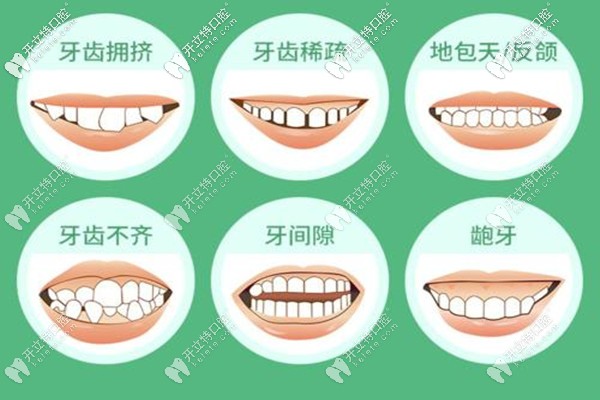 蘭州牙王國口腔金屬矯正，舌側矯正多少錢