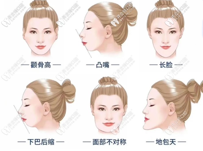 牙齒矯正適應(yīng)癥 牙齒矯正適應(yīng)癥