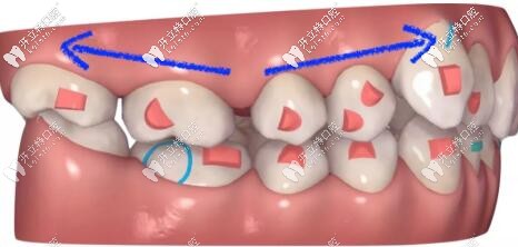 凸嘴齙牙正畸拔智齒推磨牙向后和拔4號牙哪個更好?