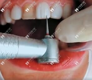 卸除樹脂牙貼面價(jià)位大概多少錢一個(gè)?水激光卸除價(jià)格了解下