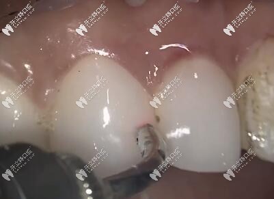 水激光卸除貼面