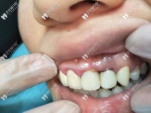 烤瓷牙根尖囊腫