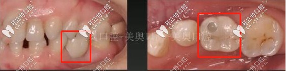 36歲的缺牙者做單顆種植牙