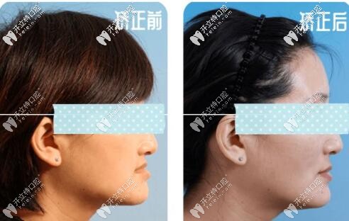 骨性地包天矯正案例