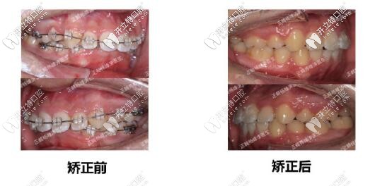 唐山牙博士口腔正畸案例