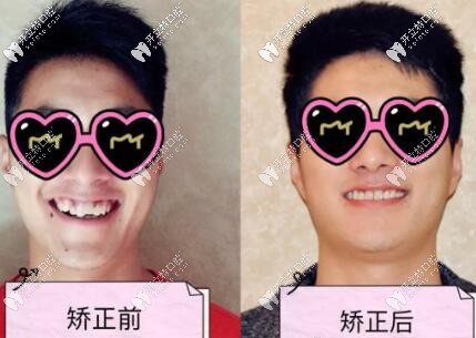 唐山牙博士口腔尚有明醫(yī)生正畸案例