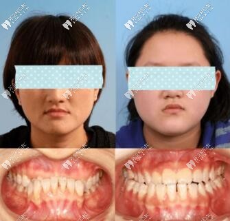 骨性三類反頜掩飾性正畸案例效果圖,隱形和鋼牙套哪個好