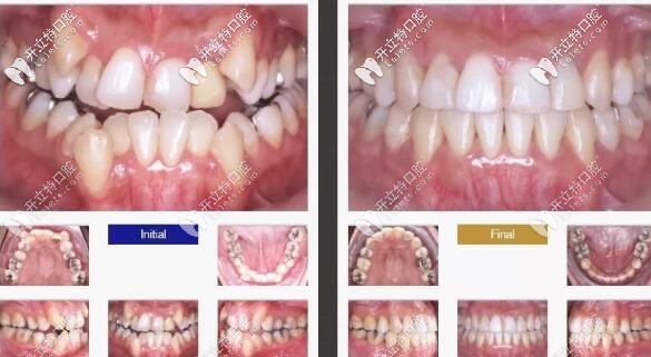 骨性三類反頜掩飾性正畸案例