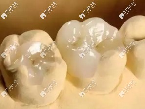 補(bǔ)牙材料脫落的常見(jiàn)因素有哪些