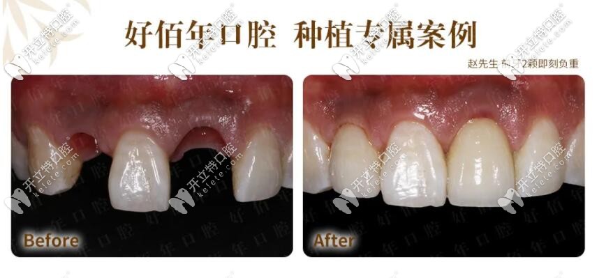 前牙即刻負(fù)重種植牙案例