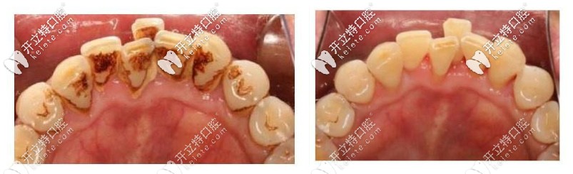 洗牙前后對比照