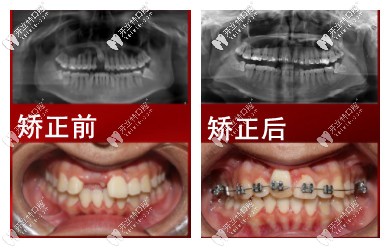 矯正前后對(duì)比