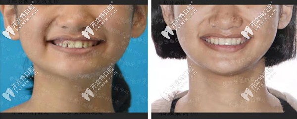 長(zhǎng)沙牙祖口腔沙米矯正案例二